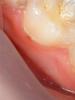 Is it necessary to remove wisdom teeth or is it better to try to treat them?