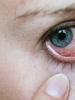 Красные глаза у взрослых и детей: причины, лечение