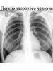 Zdjęcie rentgenowskie w przypadku zapalenia płuc Diagnostyka rentgenowska przewlekłego zapalenia płuc